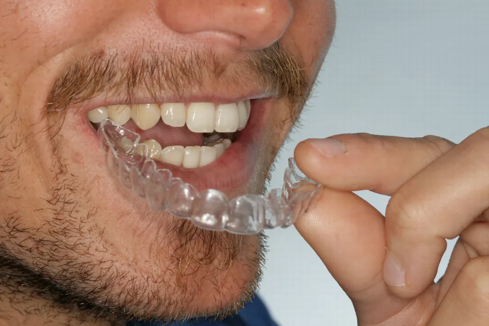Primer plano de una boca sonriendo con un alineador transparente, sujeto con los dedos, sobre los dientes de abajo