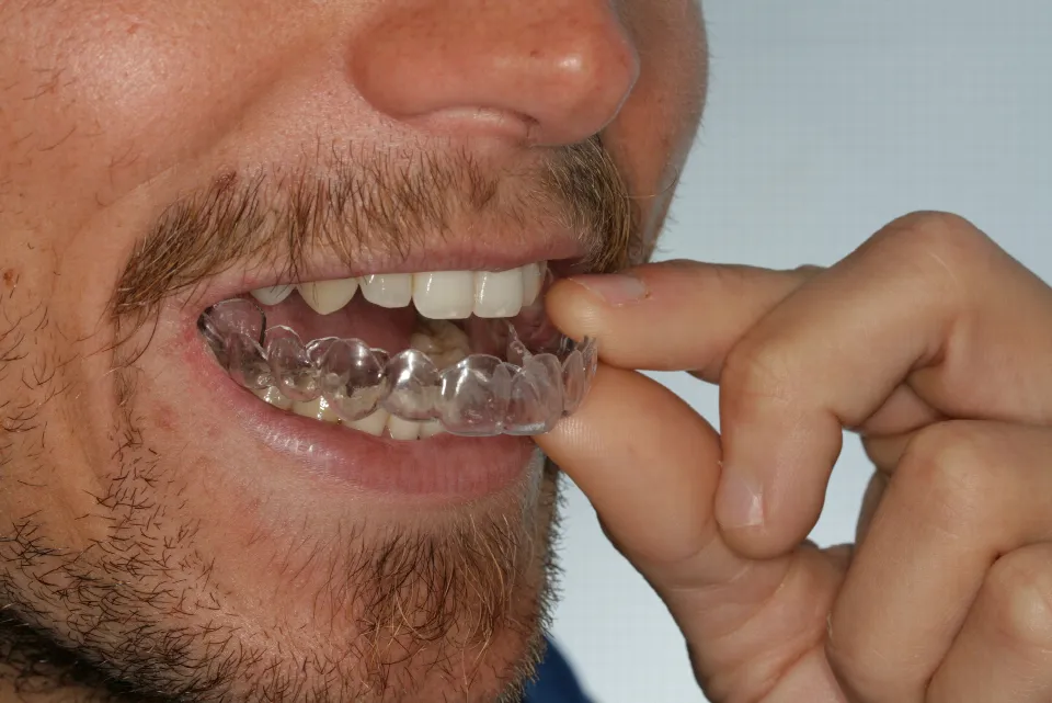Un alineador transparente puesto sobre los dientes, sujeto con dos dedos